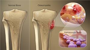 Essential Insights and How to Find the Best Osteomyelitis Doctor for Optimal Treatment