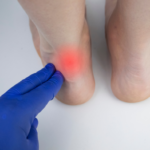 Professional Achilles Tendinopathy Care in Edinburgh Clinics