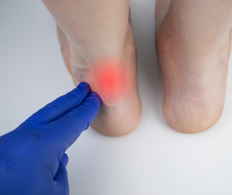 Professional Achilles Tendinopathy Care in Edinburgh Clinics