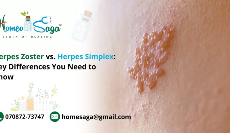 Herpes Zoster vs. Herpes Simplex: The Importance of Self-Care